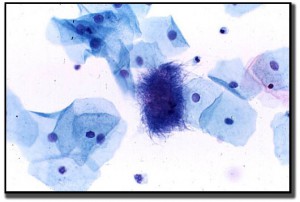 actinomyces-clinical-large-BDR