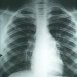 lung xray_CDC PHIL