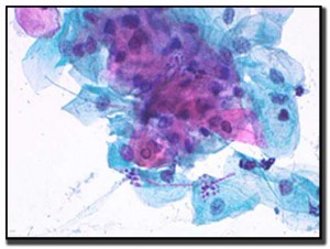 candida-pap-stained-large-BDR