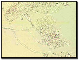 candidiasis-wet-mount-2-lg-BDR