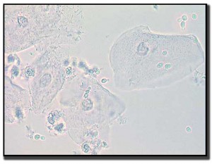 candidiasis-wet-mount-lg-BDR