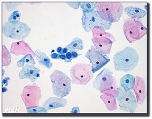 high-grade-squamous-lesion-2-BDR