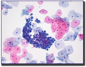 high-grade-squamous-lesion--BDR1