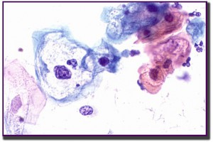 low-gradeHPV-BDR