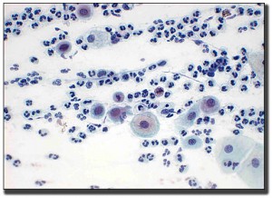 parabasal_squamous_cells-BDR