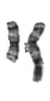translocation between the long arms of both chromosome 3