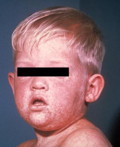 boy with measles rash on his face